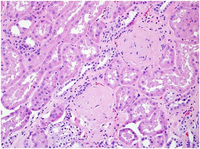 Association of Ancillary Pathology Findings in Non-neoplastic Renal Parenchyma and Renal Outcomes of Robotic-Assisted Partial Nephrectomy